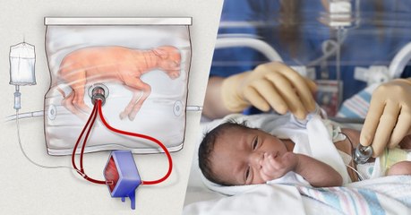 Cet utérus artificiel pourrait venir en aide aux grands prématurés