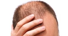 Calvitie : une nouvelle piste découverte pour stimuler la repousse des cheveux ?