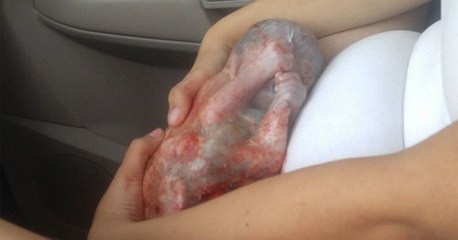 Un bébé vient au monde dans son sac amniotique aux Etats-Unis