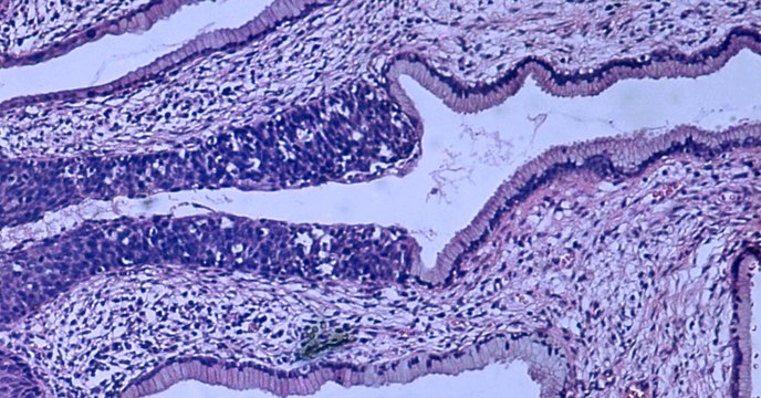Cancer du col de l'utérus : l'Australie serait en passe d'éradiquer la maladie