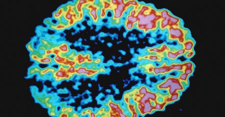 Une nouvelle approche prometteuse pour traiter la maladie d'Alzheimer