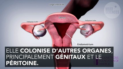Endométriose : 3 choses que vous ne saviez (peut-être) pas sur cette maladie