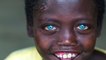Syndrome de Waar­den­burg : une mutation génétique a donné des yeux bleu électrique aux membres d'une tribu indonésienne