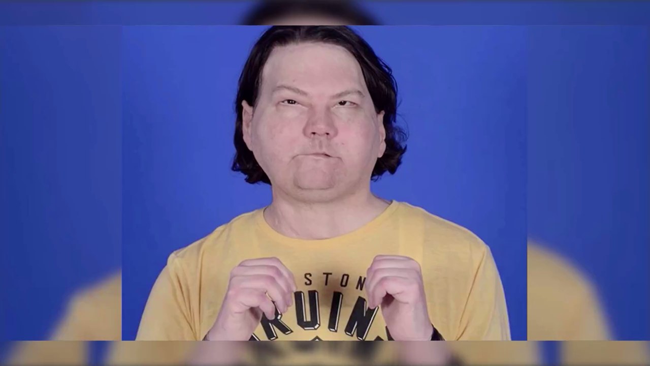 New York : le résultat bluffant de la première triple greffe réussie du visage et des deux mains sur un jeune homme