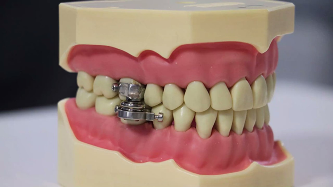 Obésité : des chercheurs mettent au point un verrou pour mâchoire permettant de perdre du poids