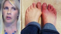 Erythromelalgie : elle souffre de douleurs au pied, les médecins diagnostiquent une infection. Mais c'était beaucoup plus grave