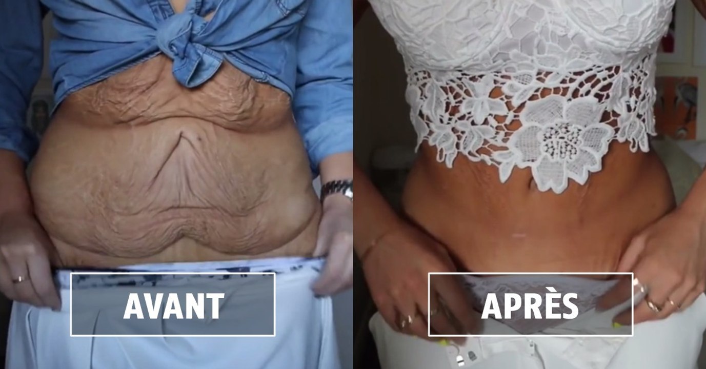 Voici toutes les bonnes astuces pour éviter la peau distendue après une perte de poids importante