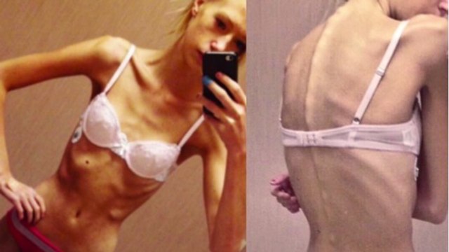 Anorexie : cette femme s'est battue pour vivre