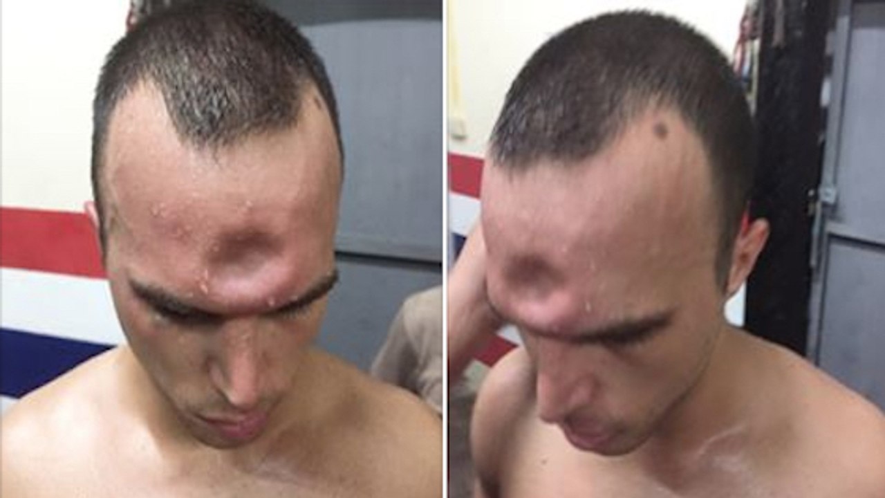 Muay-Thai-Kämpfer bekommt Ellenbogenschlag ab. Erst später begreift er, was da passiert ist