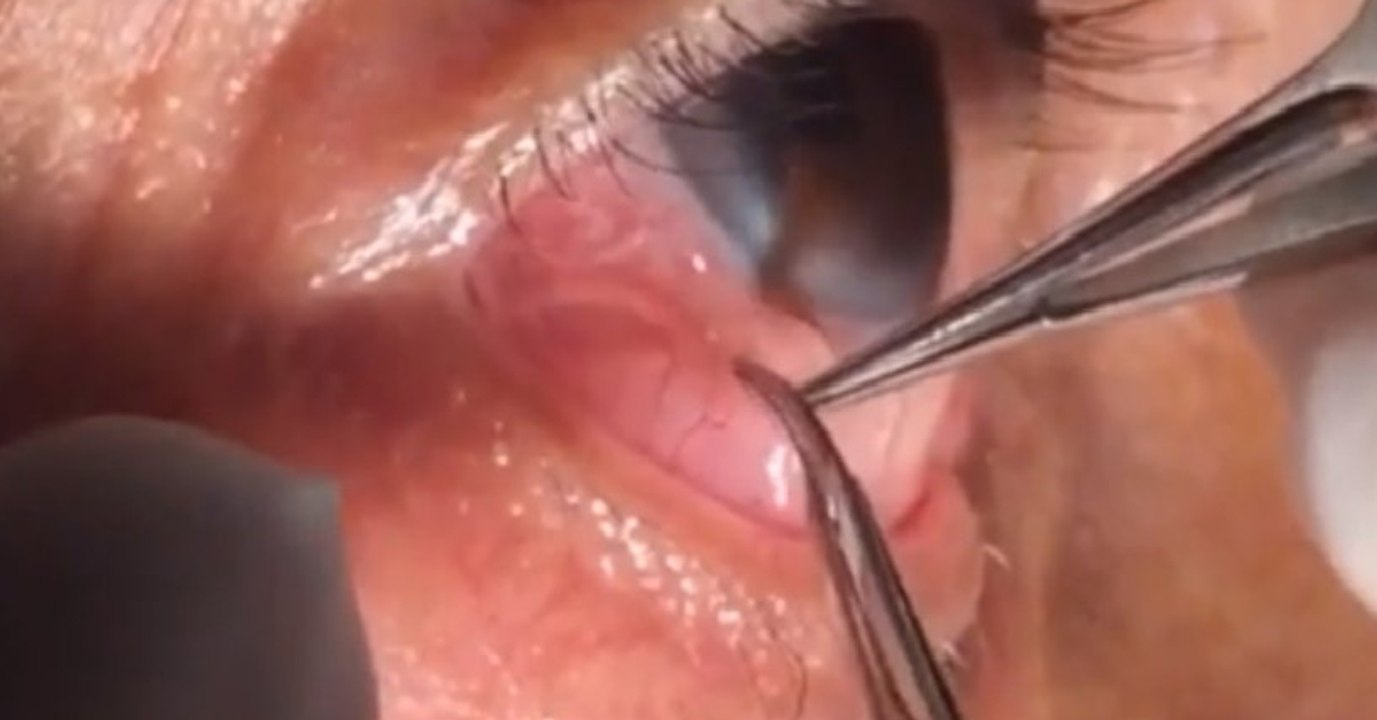 Arzt entfernt 15 cm langen Wurm aus Auge seines Patienten