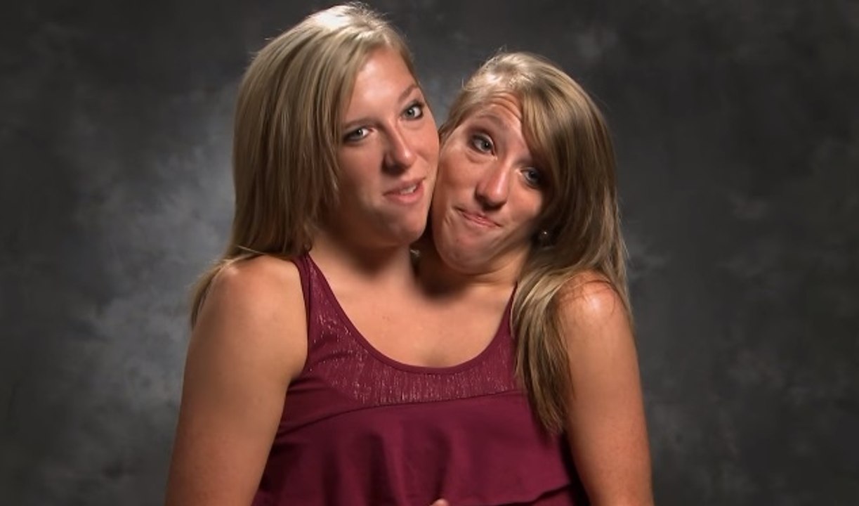 Siamesische Zwillinge: Eine von beiden will heiraten