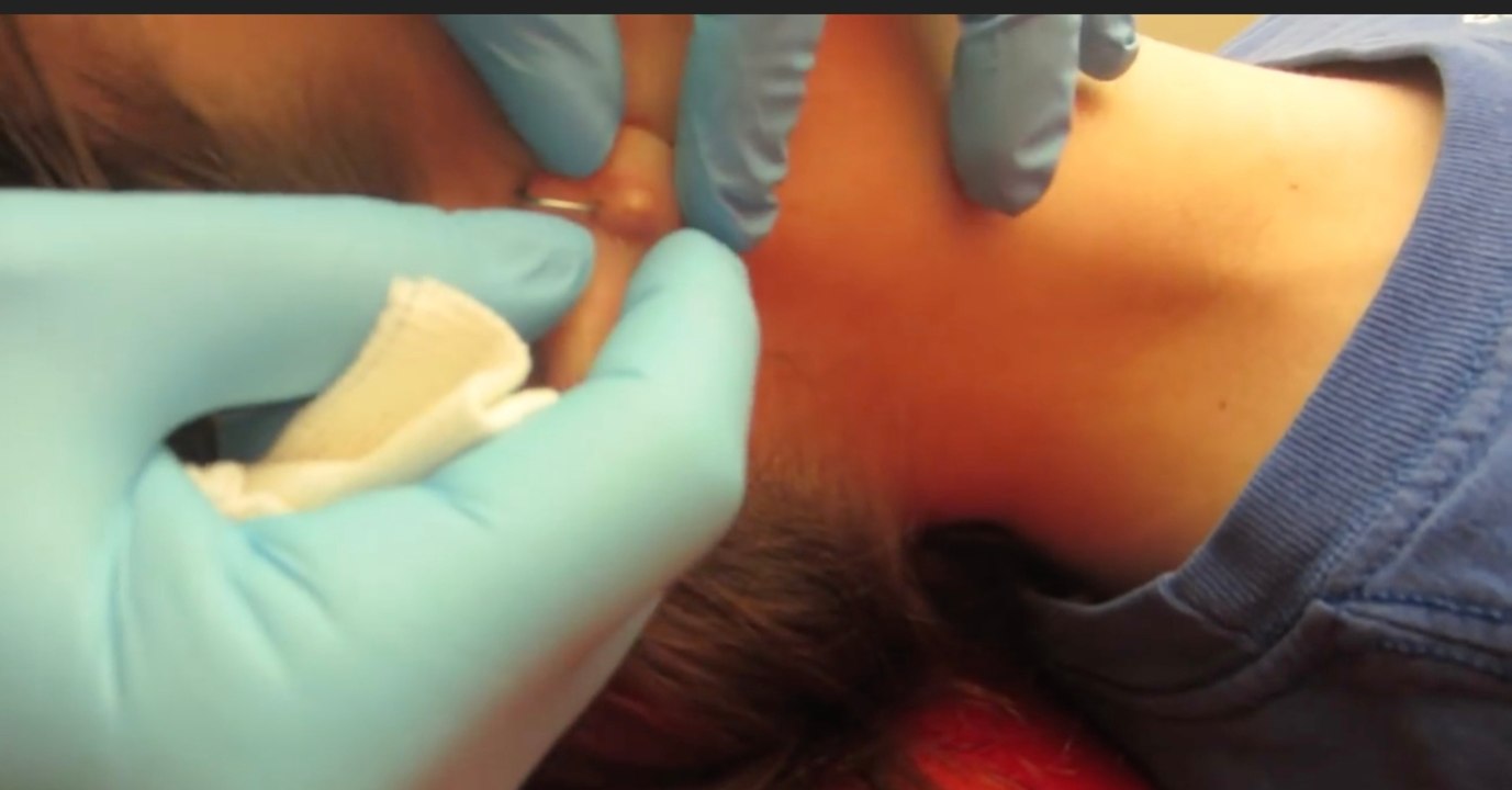 Schlimme Infektion nach Ohrenpiercing: Der Arzt muss hineinstechen