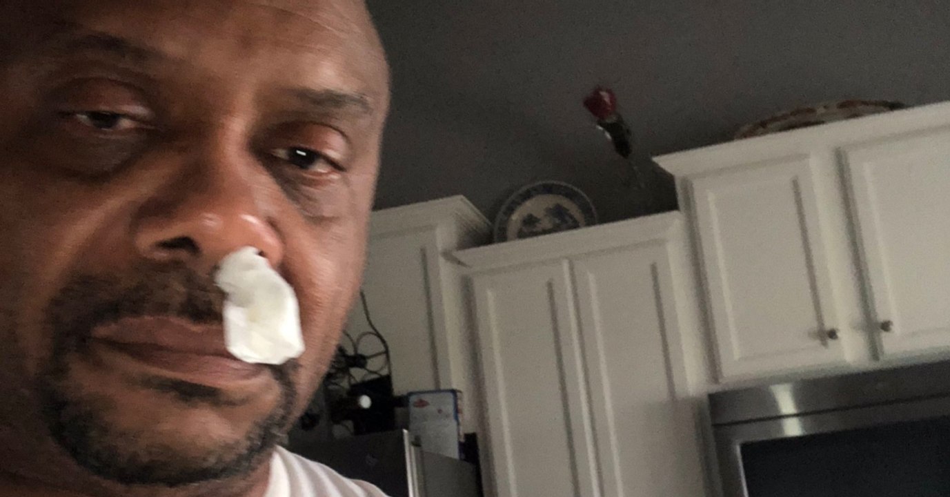 Von wegen Schnupfen: Ärzte schockiert, was dem Mann wirklich aus der Nase tropft