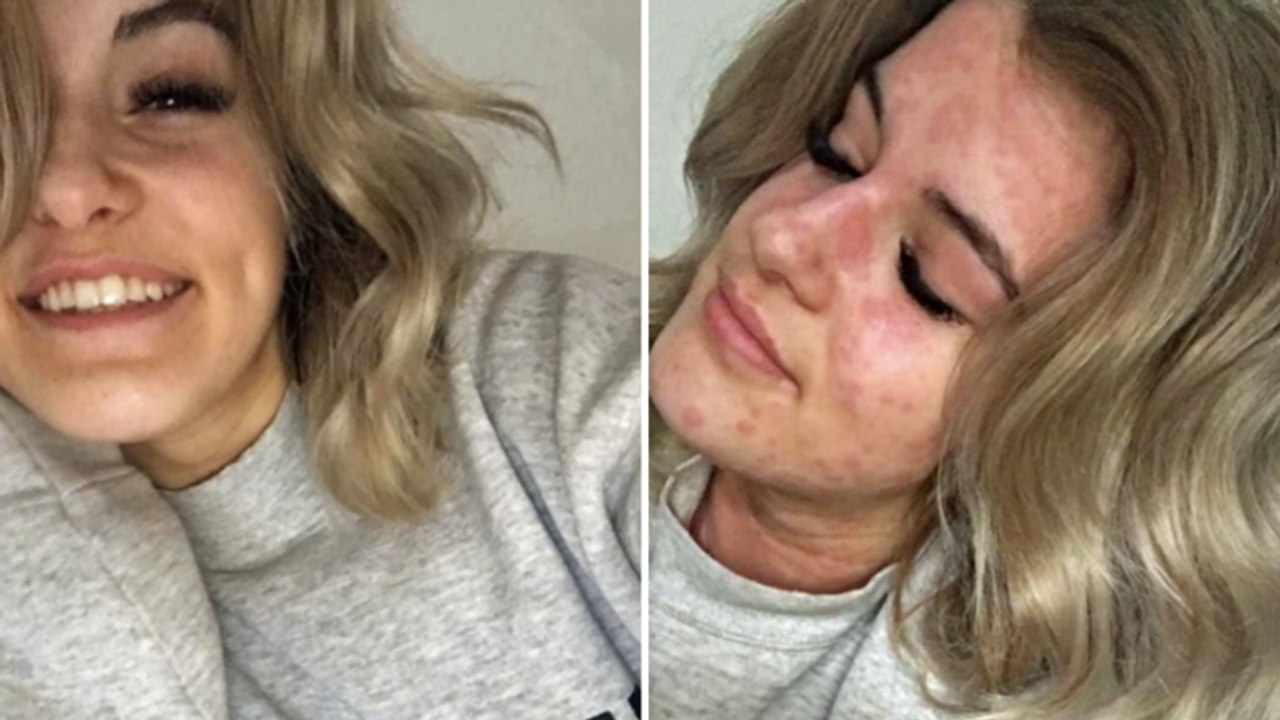 Kälteallergie: 21-jährige muss wegen kälte den tod befürchten