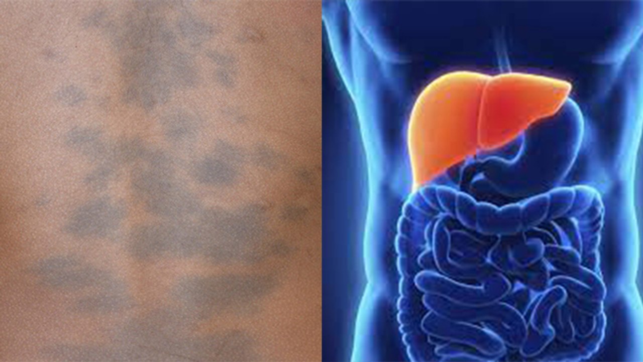 लिवर से जुड़ी खतरनाक बीमारी का संकेत है त्वचा में ये बदलाव ,जानिए लक्षण और कारण । Boldsky