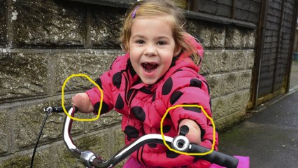 Cette fillette était condamnée à ne jamais pouvoir faire de vélo. Aujourd'hui, elle y arrive