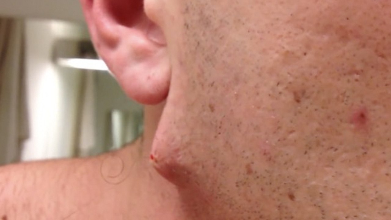 Er erlebt eine ekelige Überraschung, als er sich dieses überlange haar aus dem kinn zieht (video)