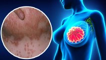 Skin में ऐसे बदलाव ब्रेस्ट कैंसर के लक्षण हो सकते है,तुरंत कराए जांच |Doctors Alert | Boldsky