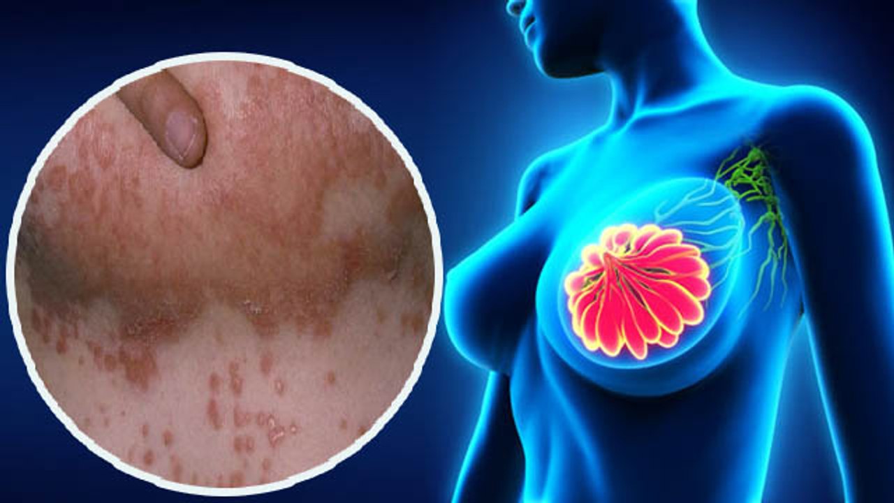 Skin में ऐसे बदलाव ब्रेस्ट कैंसर के लक्षण हो सकते है,तुरंत कराए जांच |Doctors Alert | Boldsky
