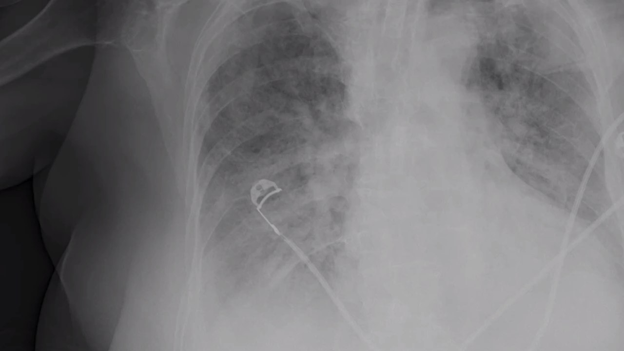 Corona: So wirken sich die Langzeitschäden von Covid-19 auf die Lunge aus