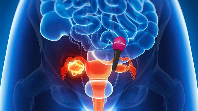 Rahim kanseri nedir? Belirtileri nelerdir? Op. Dr. Nazlı Oral Korkmaz açıklıyor