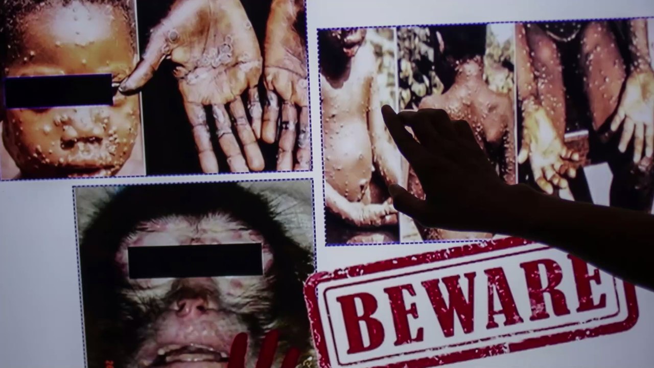 Zwei Fälle von Affenpocken in Großbritannien aufgetaucht