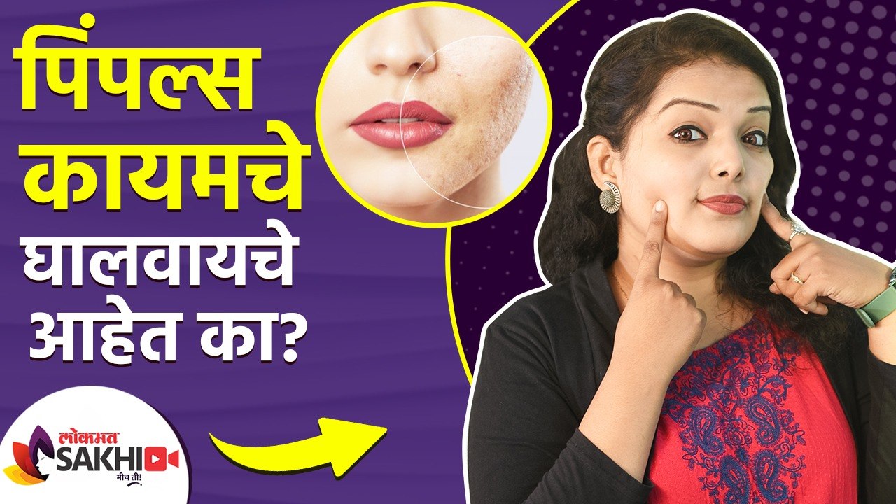 पिंपल्स पासून झटपट सुटका कशी मिळवायची | How to...