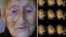 Âgée de 92 ans, cette femme apprend qu'elle porte un foetus mort depuis plus de 50 ans dans son abdomen