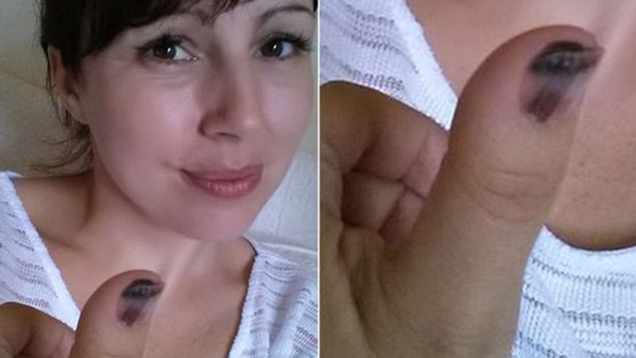 Elle croit avoir une verrue sous l'ongle, mais les médecins font une terrible découverte