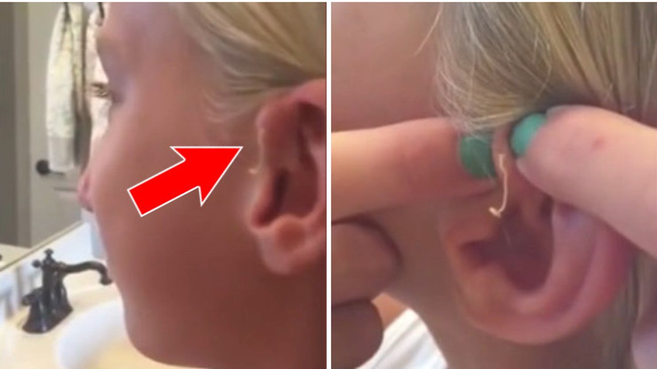 Elle se perce un bouton vieux de 6 ans sur l'oreille