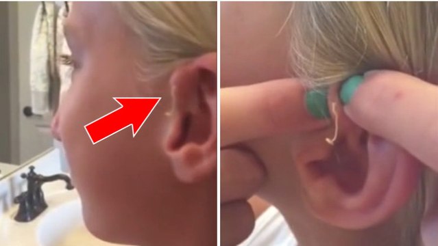 Elle se perce un bouton vieux de 6 ans sur l'oreille