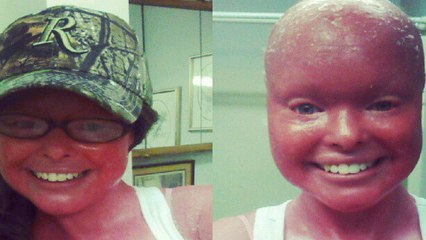 Atteinte du syndrome d'Arlequin, son histoire va vous bouleverser