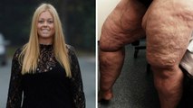 Atteinte d'une maladie rare, elle se fait retirer 12 litres de graisse dans les jambes