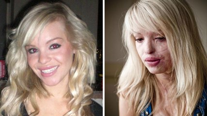 Défigurée à l'acide, aujourd'hui elle prend sa revanche sur la vie