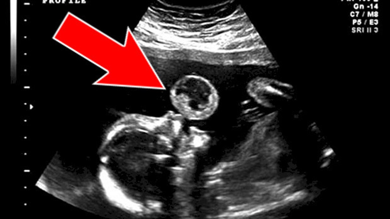 L'échographie de ce bébé 'faisant une bulle' cache une terrible réalité