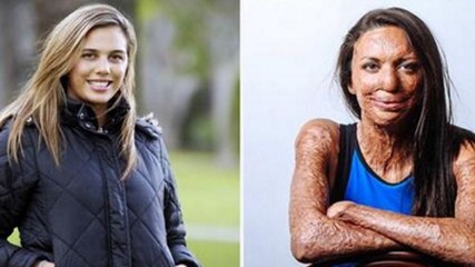 Brûlée au 3ème degré, cette femme a le meilleur mari au monde