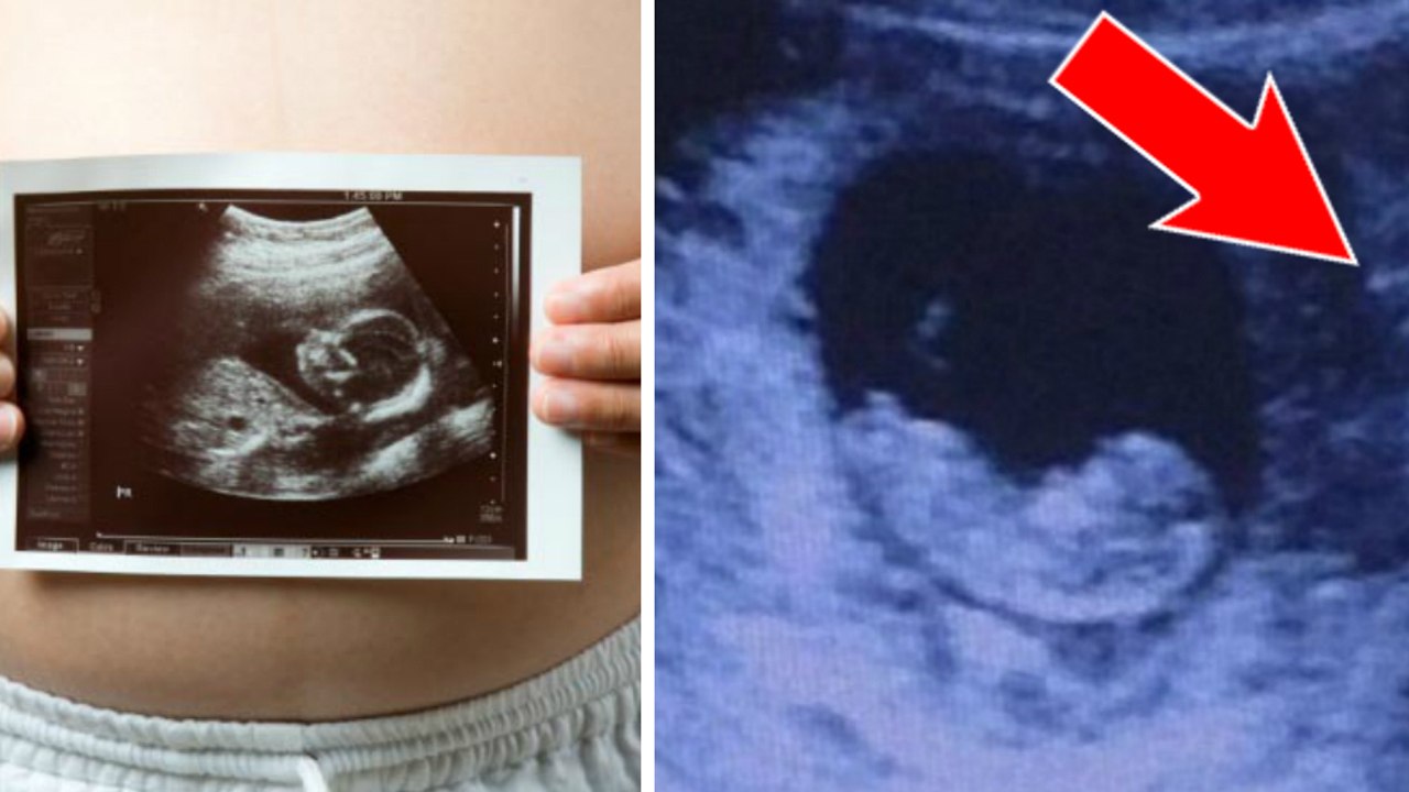 Enceinte de 10 semaines, elle fait une terrifiante découverte sur son échographie