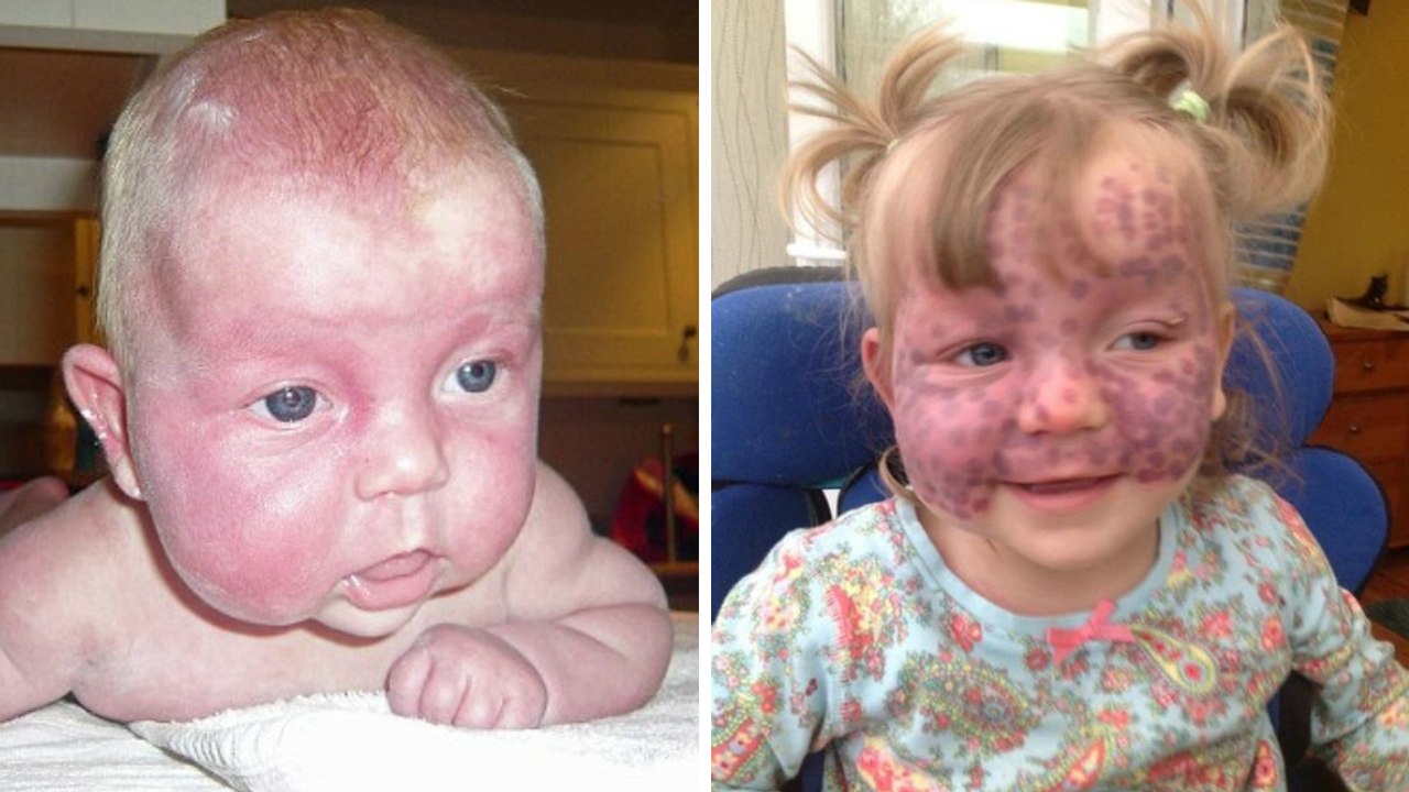 A 5 ans, cette fillette atteinte d'une maladie extrêmement rare émeut tout le web