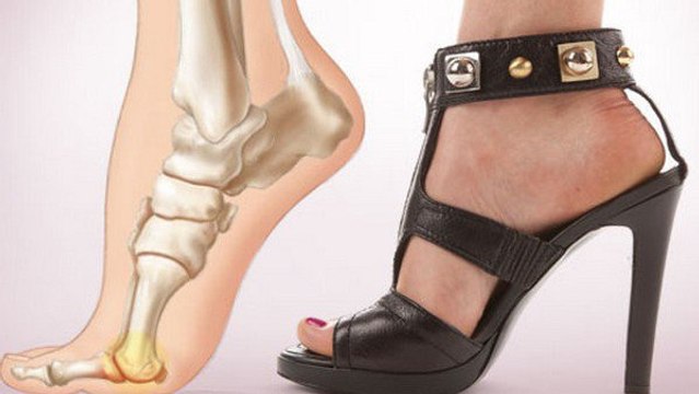 Voici pourquoi les talons hauts sont dangereux pour la santé