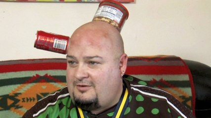 A cause d'une rare maladie de peau, cet homme peut se coller des canettes sur le crâne