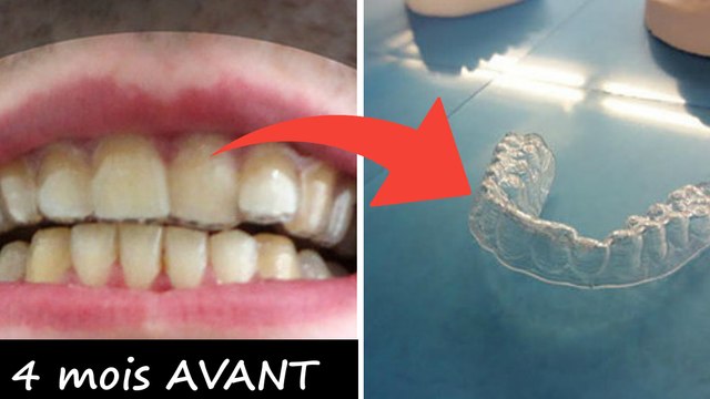 Il crée son propre appareil dentaire et quatre mois plus tard le résultat est impressionnant