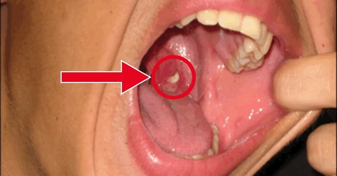 Les pierres d'amygdales peuvent être la cause d'une mauvaise haleine