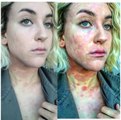 L'actrice Ciena Rae Nelson poste des photos de son psoriasis pour faire passer un message fort !