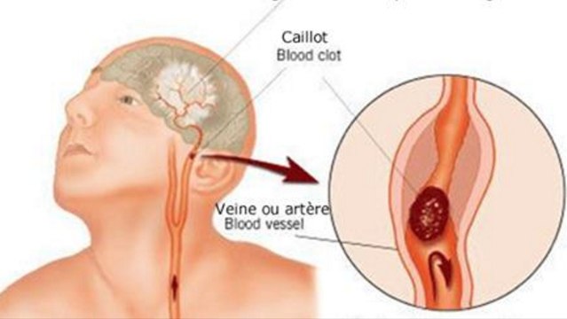Comment reconnaitre les signes de l'AVC ? Partagez cette information avec vos proches