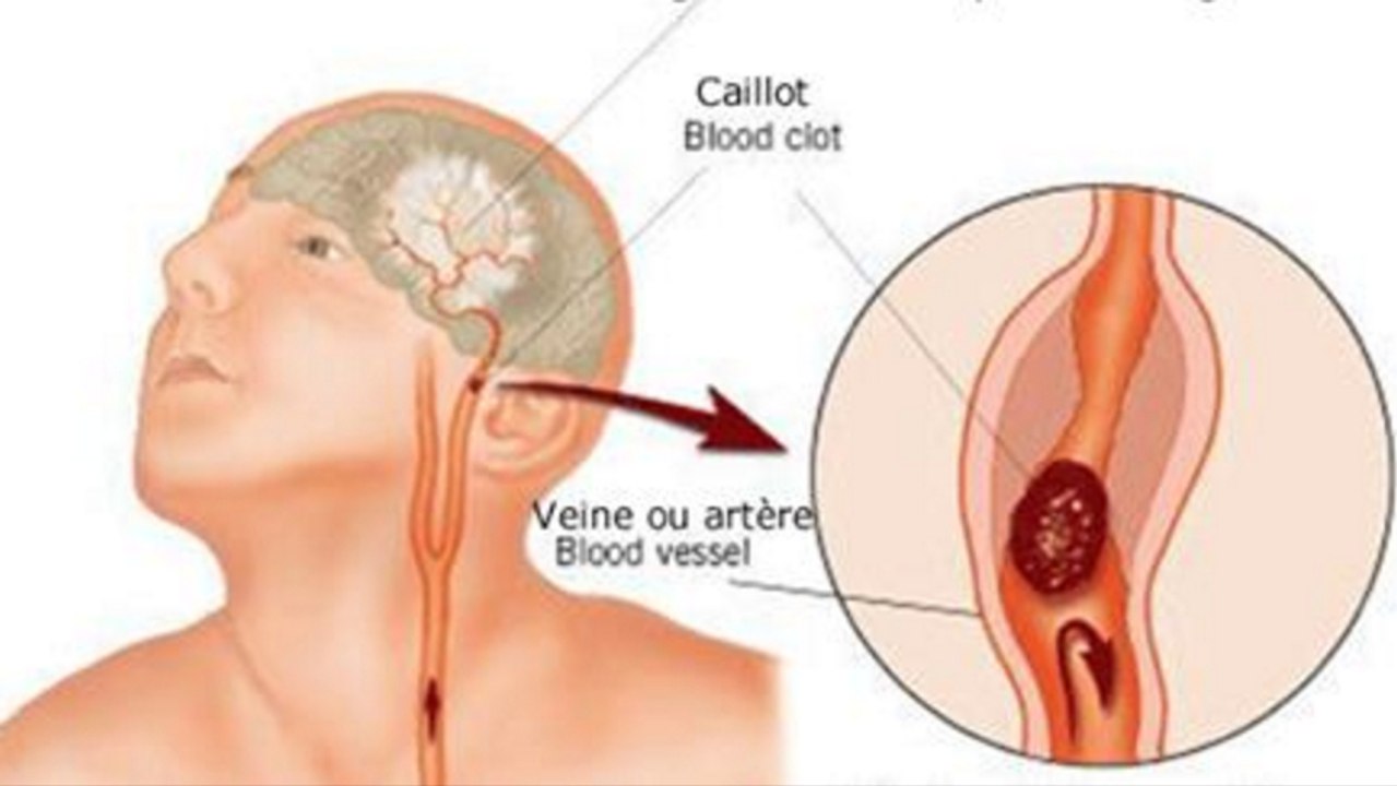 Comment reconnaitre les signes de l'AVC ? Partagez cette information avec vos proches