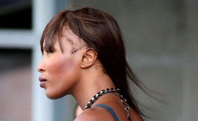 L'alopécie de traction: un fléau capillaire méconnu