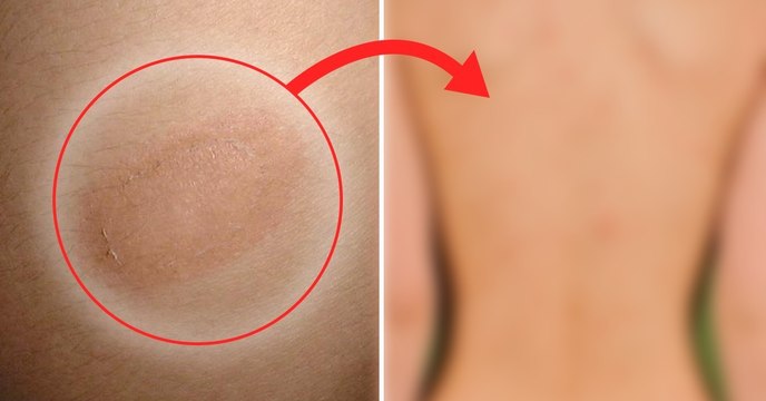 Le pityriasis rosé de Gibert, une maladie rare qui recouvre votre corps de plaques rouges