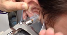 Un médecin injecte de l'eau dans l'oreille d'un patient. Ce qui en sort est inimaginable !