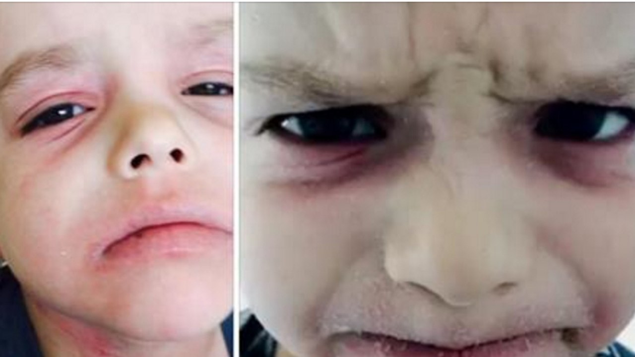 Dermatite atopique: Tyler Saunders était entièrement recouvert d'eczéma avant de trouver un spécialiste à l'autre bout du monde