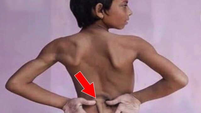 Inde : un garçon se fait retirer une queue de 18 centimètres